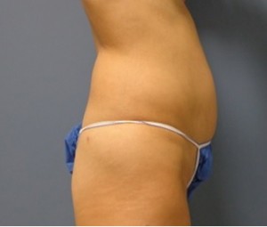 Tummy Tuck Before and After Pictures Nashville, TN