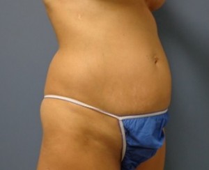 Tummy Tuck Before and After Pictures Nashville, TN