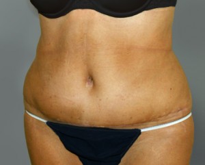 Tummy Tuck Before and After Pictures Nashville, TN