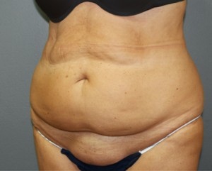 Tummy Tuck Before and After Pictures Nashville, TN