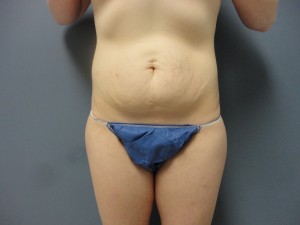 Tummy Tuck Before and After Pictures Nashville, TN