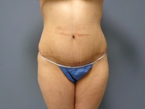 Tummy Tuck Before and After Pictures Nashville, TN