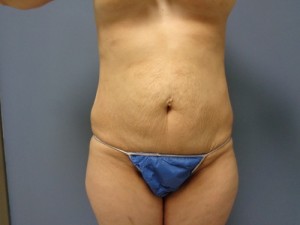 Tummy Tuck Before and After Pictures Nashville, TN