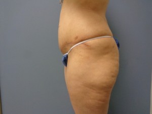 Tummy Tuck Before and After Pictures Nashville, TN