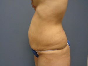 Tummy Tuck Before and After Pictures Nashville, TN