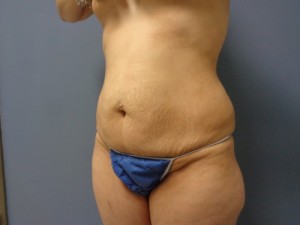 Tummy Tuck Before and After Pictures Nashville, TN