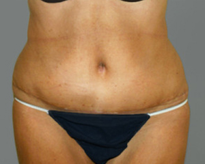 Tummy Tuck Before and After Pictures Nashville, TN