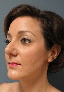 Rhinoplasty Before and After Pictures Nashville, TN