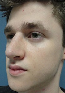 Rhinoplasty Before and After Pictures Nashville, TN