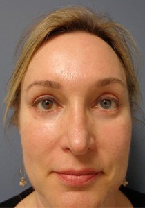 Rhinoplasty Before and After Pictures Nashville, TN