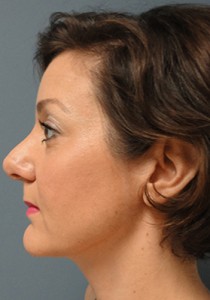Rhinoplasty Before and After Pictures Nashville, TN