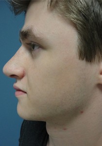 Rhinoplasty Before and After Pictures Nashville, TN