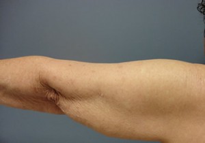 Arm Lift Before and After Pictures Nashville, TN