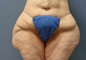 Thigh Lift Before and After Pictures Nashville, TN