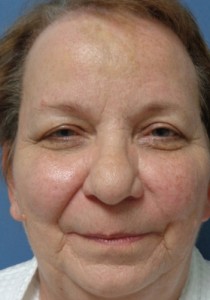 Rhinoplasty Before and After Pictures Nashville, TN