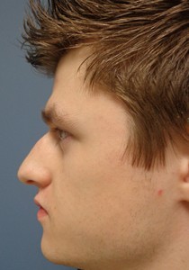 Rhinoplasty Before and After Pictures Nashville, TN