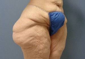 Thigh Lift Before and After Pictures Nashville, TN