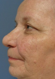 Rhinoplasty Before and After Pictures Nashville, TN