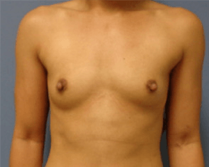 Breast Augmentation Before and After Pictures Nashville, TN