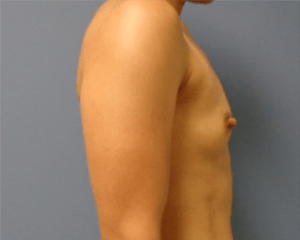 Breast Augmentation Before and After Pictures Nashville, TN