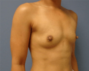 Breast Augmentation Before and After Pictures Nashville, TN