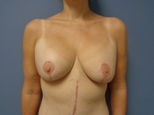 Breast Augmentation with Lift Before and After Pictures Nashville, TN
