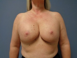 Breast Reconstruction Before and After Pictures Nashville, TN