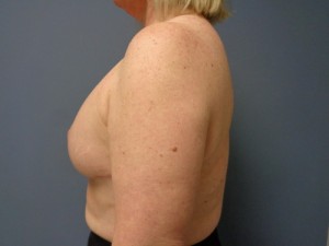 Breast Reconstruction Before and After Pictures Nashville, TN