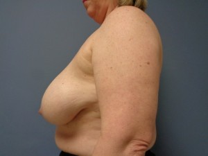 Breast Reconstruction Before and After Pictures Nashville, TN