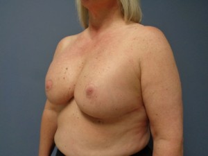 Breast Reconstruction Before and After Pictures Nashville, TN