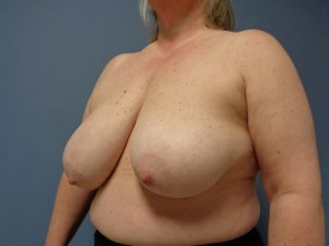 Breast Reconstruction Before and After Pictures Nashville, TN
