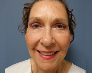 Facelift Before and After Pictures Nashville, TN