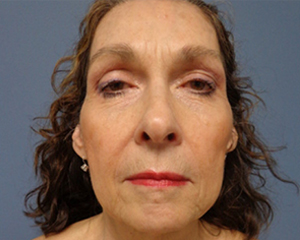 Facelift Before and After Pictures Nashville, TN
