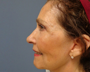 Facelift Before and After Pictures Nashville, TN