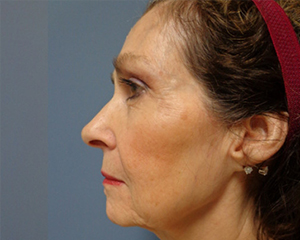 Facelift Before and After Pictures Nashville, TN