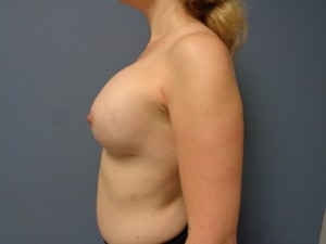 Implant Based Reconstruction Before and After Pictures Nashville, TN