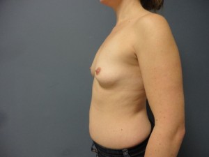 Implant Based Reconstruction Before and After Pictures Nashville, TN