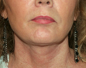 Neck Lift Before and After Pictures Nashville, TN