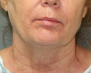 Neck Lift Before and After Pictures Nashville, TN