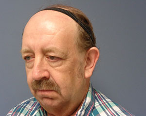 Otoplasty Before and After Pictures Nashville, TN