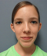 Otoplasty Before and After Pictures Nashville, TN