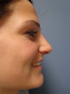 Rhinoplasty Before and After Pictures Nashville, TN