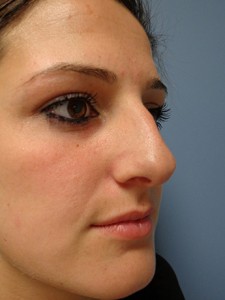 Rhinoplasty Before and After Pictures Nashville, TN