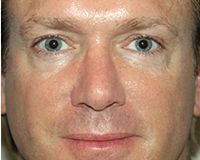 Rhinoplasty Before and After Pictures Nashville, TN