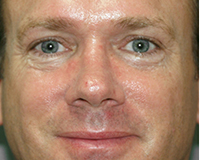 Rhinoplasty Before and After Pictures Nashville, TN