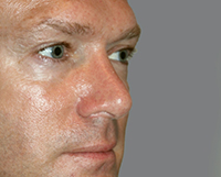 Rhinoplasty Before and After Pictures Nashville, TN