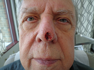 Skin Cancer Closure Before and After Pictures Nashville, TN