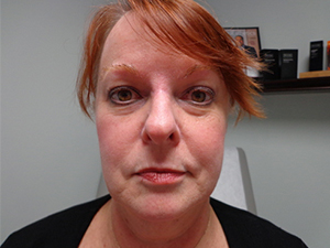 Skin Cancer Closure Before and After Pictures Nashville, TN