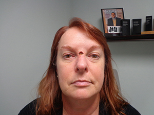 Skin Cancer Closure Before and After Pictures Nashville, TN