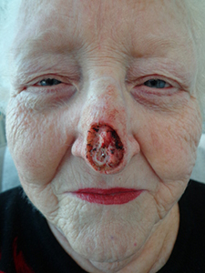 Skin Cancer Closure Before and After Pictures Nashville, TN